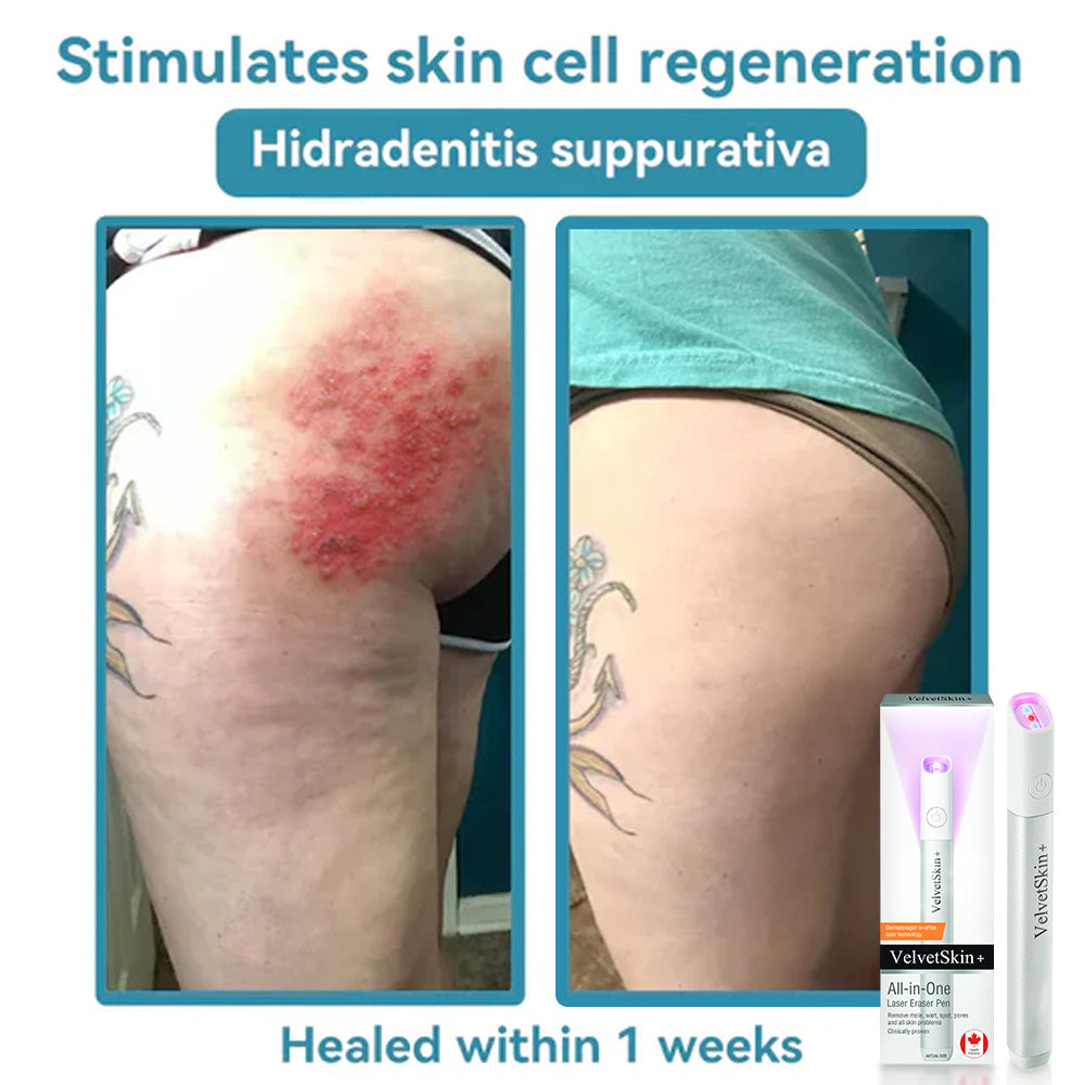 ✨ All-in-One CO₂ Laser Eraser Pen | Removes Moles, Warts, Skin Flaws & Pigmentation