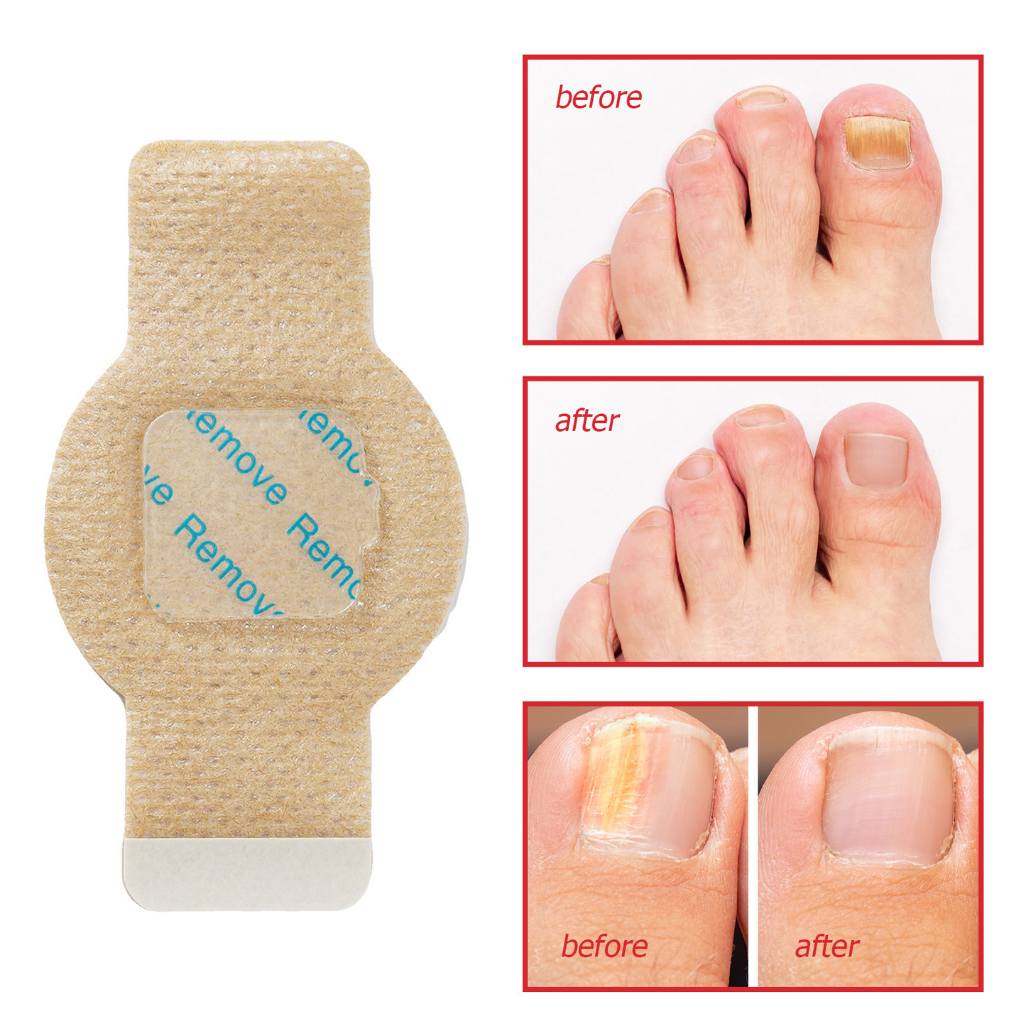 Fungal Nail Patches -- Fast, Effective, Long-Lasting, 21 Pcs / Set
