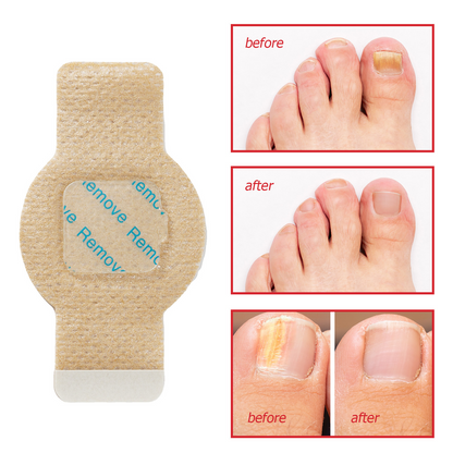 Fungal Nail Patches -- Fast, Effective, Long-Lasting, 21 Pcs / Set